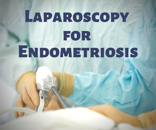 Minimal Access Surgery For Diagnosis of Endometriosis ​